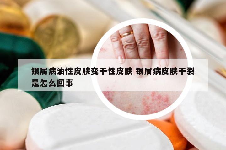 银屑病油性皮肤变干性皮肤 银屑病皮肤干裂是怎么回事