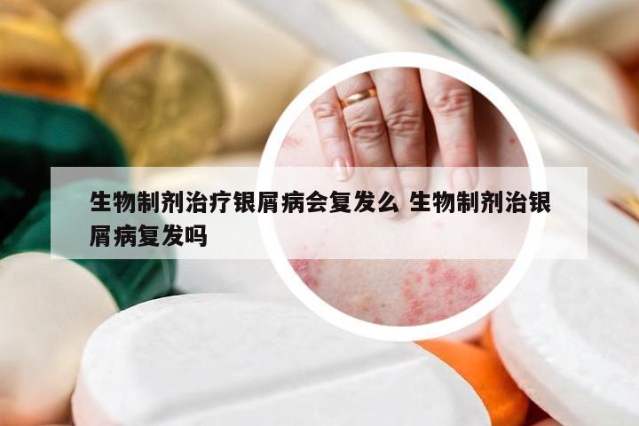 生物制剂治疗银屑病会复发么 生物制剂治银屑病复发吗