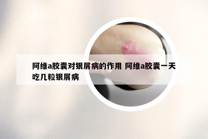 阿维a胶囊对银屑病的作用 阿维a胶囊一天吃几粒银屑病