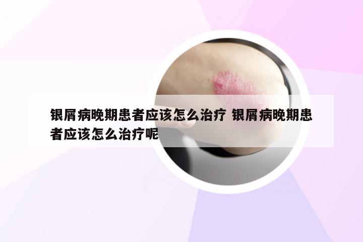 银屑病晚期患者应该怎么治疗 银屑病晚期患者应该怎么治疗呢