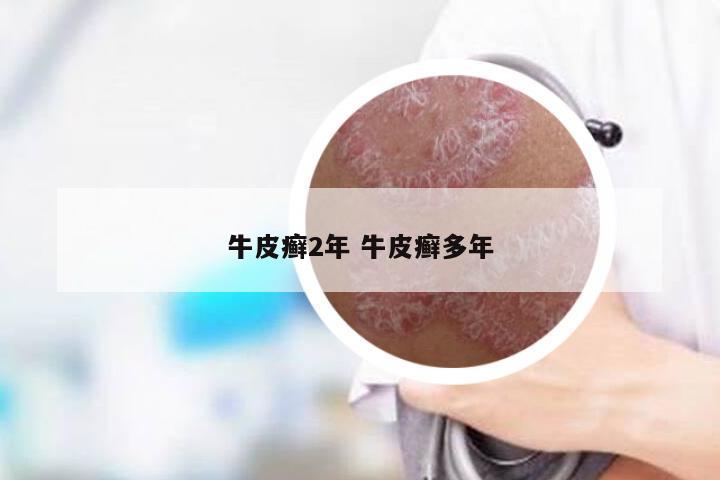 牛皮癣2年 牛皮癣多年