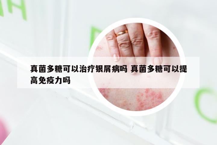 真菌多糖可以治疗银屑病吗 真菌多糖可以提高免疫力吗