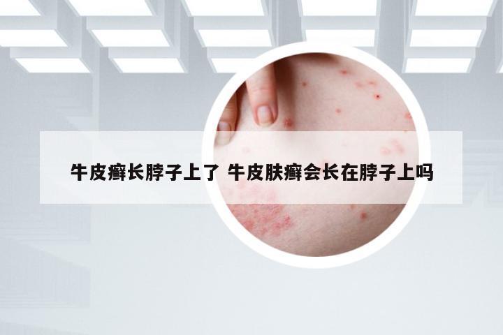 牛皮癣长脖子上了 牛皮肤癣会长在脖子上吗