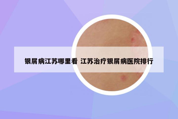 银屑病江苏哪里看 江苏治疗银屑病医院排行