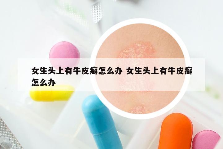 女生头上有牛皮癣怎么办 女生头上有牛皮癣怎么办