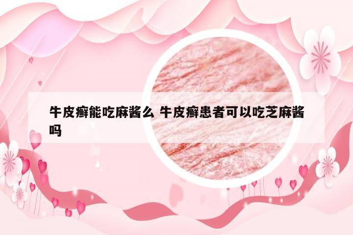 牛皮癣能吃麻酱么 牛皮癣患者可以吃芝麻酱吗