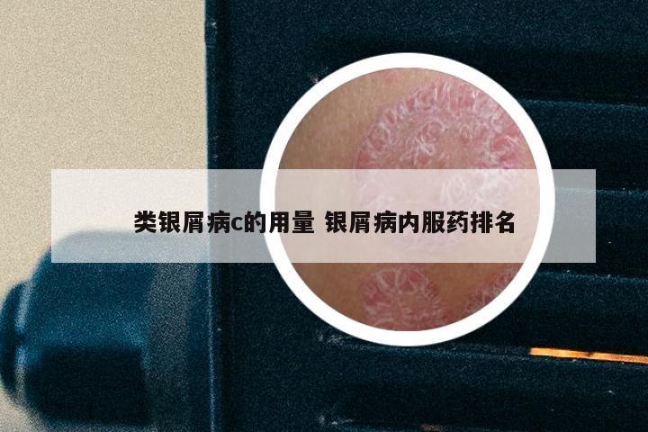 类银屑病c的用量 银屑病内服药排名