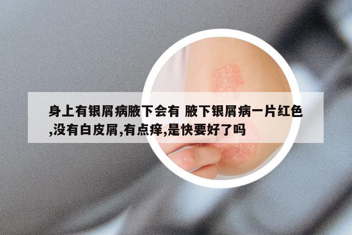 身上有银屑病腋下会有 腋下银屑病一片红色,没有白皮屑,有点痒,是快要好了吗