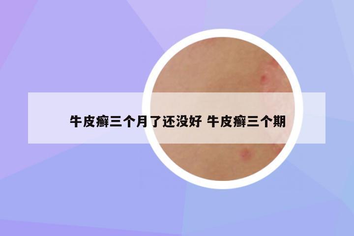 牛皮癣三个月了还没好 牛皮癣三个期