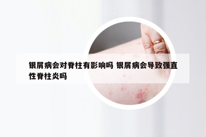银屑病会对脊柱有影响吗 银屑病会导致强直性脊柱炎吗