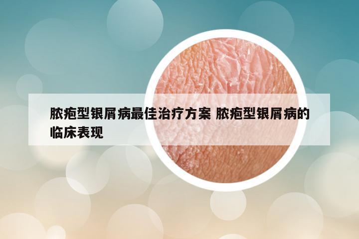 脓疱型银屑病最佳治疗方案 脓疱型银屑病的临床表现