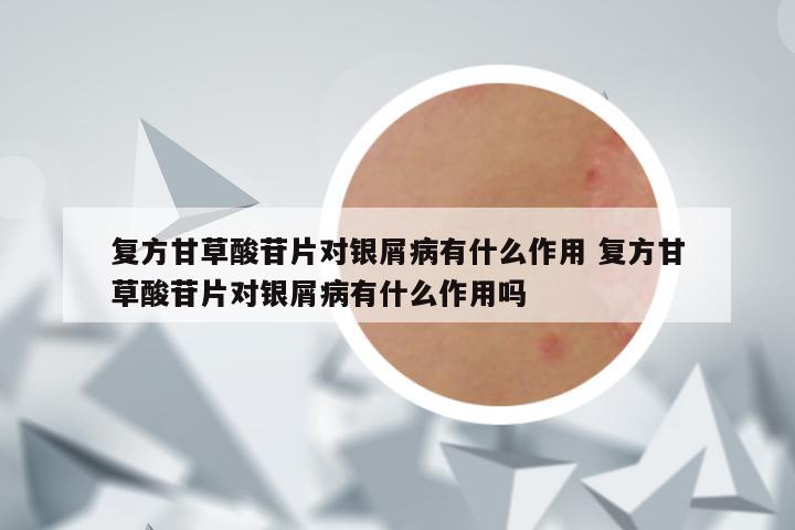 复方甘草酸苷片对银屑病有什么作用 复方甘草酸苷片对银屑病有什么作用吗