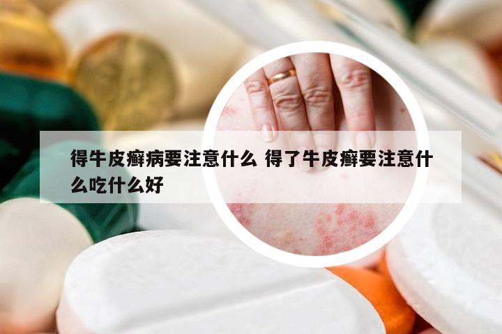 得牛皮癣病要注意什么 得了牛皮癣要注意什么吃什么好