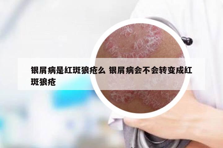 银屑病是红斑狼疮么 银屑病会不会转变成红斑狼疮