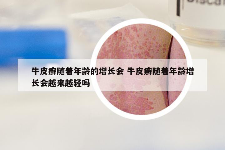 牛皮癣随着年龄的增长会 牛皮癣随着年龄增长会越来越轻吗