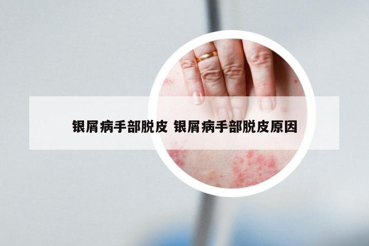 银屑病手部脱皮 银屑病手部脱皮原因