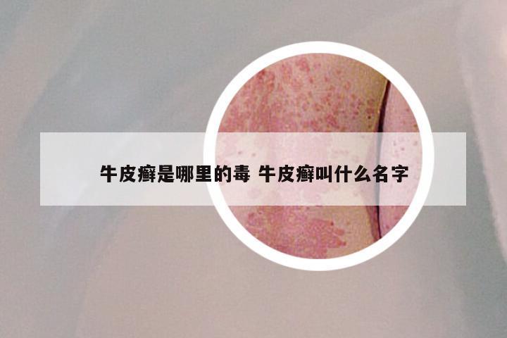 牛皮癣是哪里的毒 牛皮癣叫什么名字