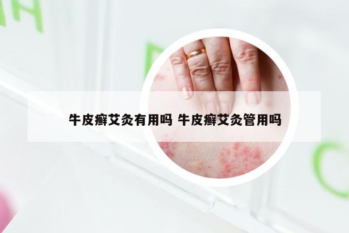 牛皮癣艾灸有用吗 牛皮癣艾灸管用吗