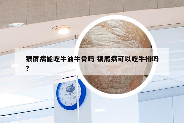 银屑病能吃牛油牛骨吗 银屑病可以吃牛排吗?