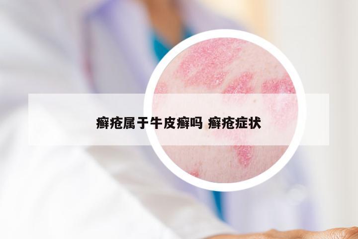 癣疮属于牛皮癣吗 癣疮症状
