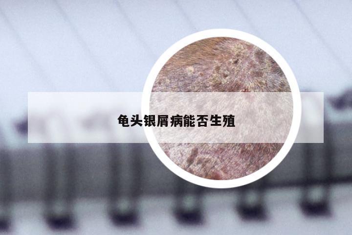 龟头银屑病能否生殖