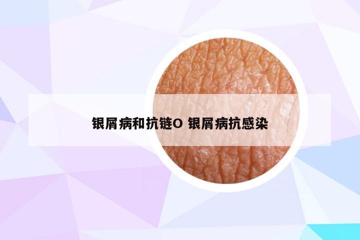 银屑病和抗链O 银屑病抗感染