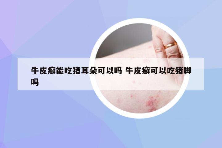 牛皮癣能吃猪耳朵可以吗 牛皮癣可以吃猪脚吗