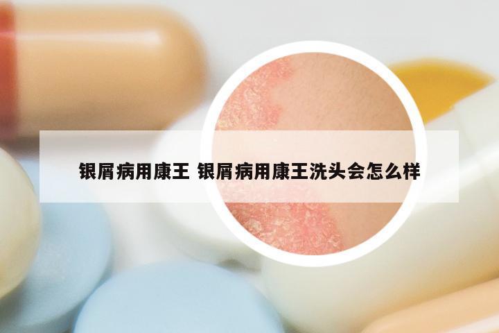 银屑病用康王 银屑病用康王洗头会怎么样