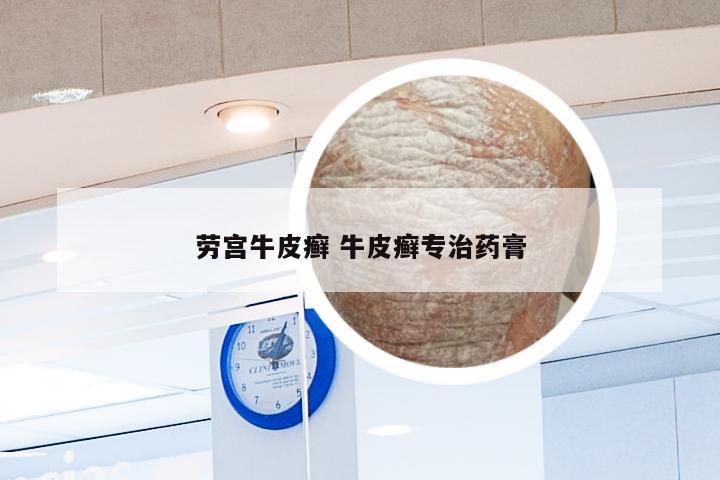 劳宫牛皮癣 牛皮癣专治药膏