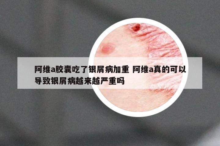 阿维a胶囊吃了银屑病加重 阿维a真的可以导致银屑病越来越严重吗