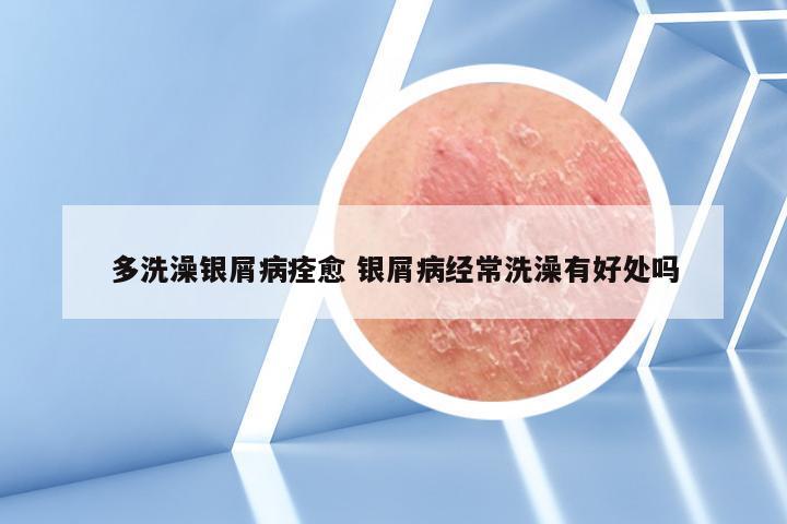 多洗澡银屑病痊愈 银屑病经常洗澡有好处吗