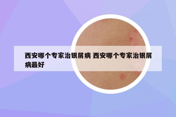 西安哪个专家治银屑病 西安哪个专家治银屑病最好