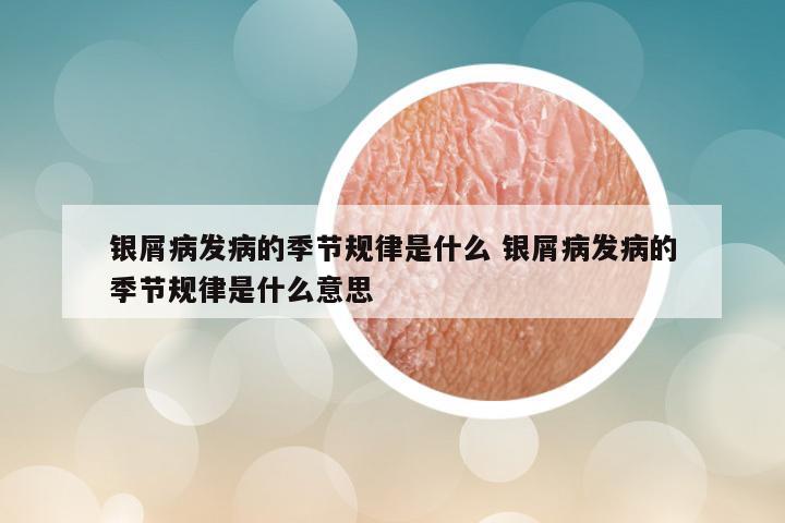 银屑病发病的季节规律是什么 银屑病发病的季节规律是什么意思