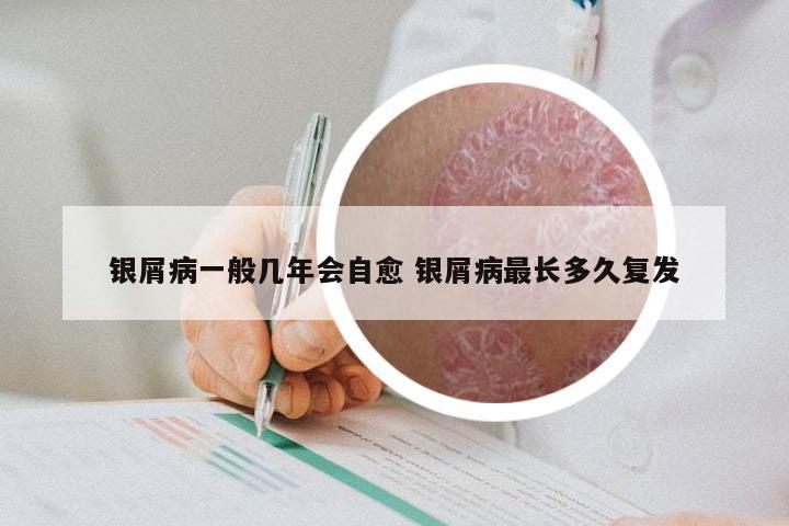 银屑病一般几年会自愈 银屑病最长多久复发