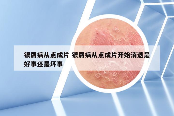 银屑病从点成片 银屑病从点成片开始消退是好事还是坏事