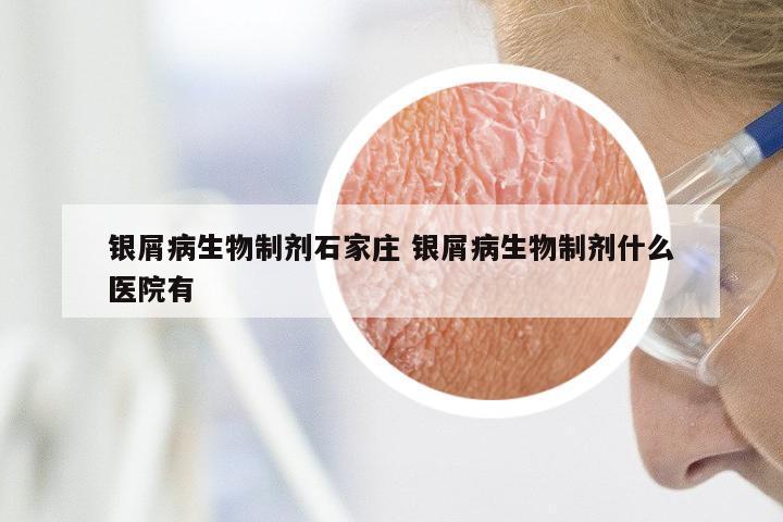 银屑病生物制剂石家庄 银屑病生物制剂什么医院有