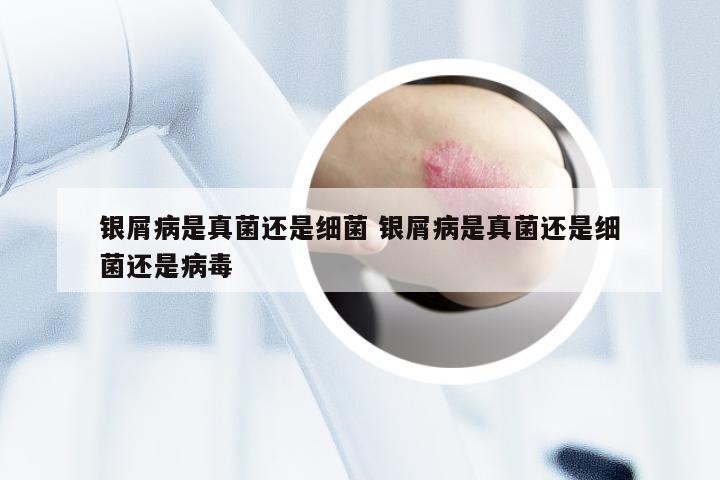 银屑病是真菌还是细菌 银屑病是真菌还是细菌还是病毒