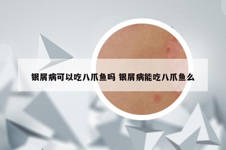 银屑病可以吃八爪鱼吗 银屑病能吃八爪鱼么