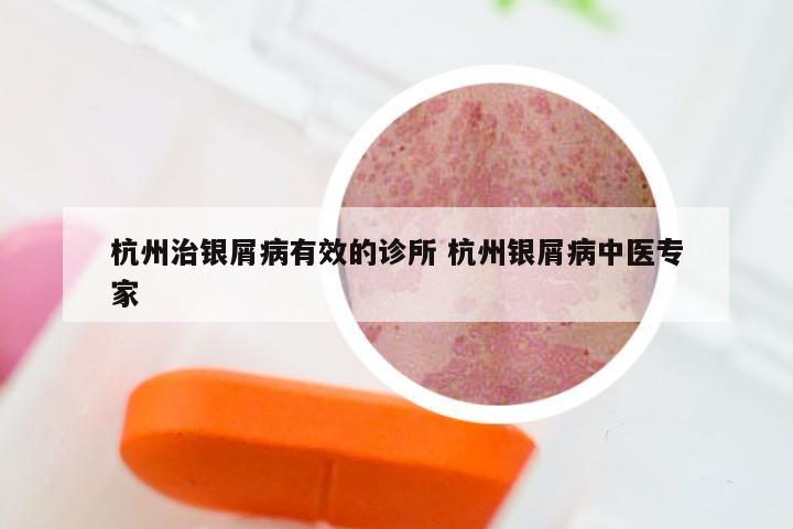杭州治银屑病有效的诊所 杭州银屑病中医专家