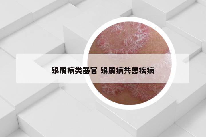 银屑病类器官 银屑病共患疾病
