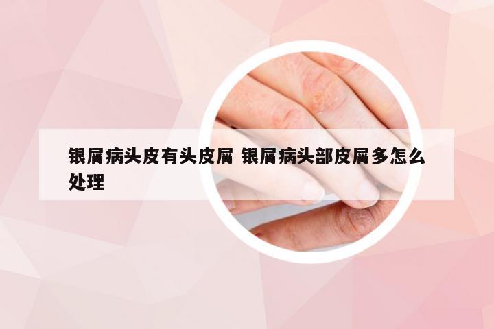 银屑病头皮有头皮屑 银屑病头部皮屑多怎么处理