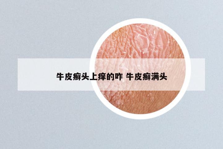 牛皮癣头上痒的咋 牛皮癣满头
