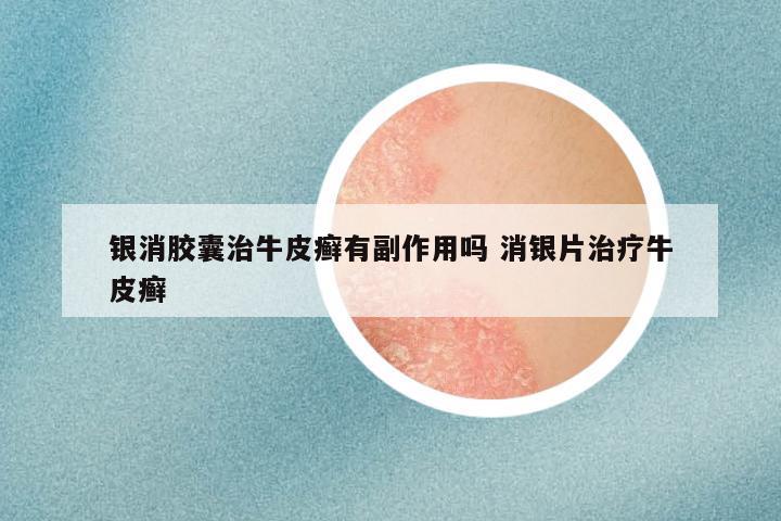 银消胶囊治牛皮癣有副作用吗 消银片治疗牛皮癣