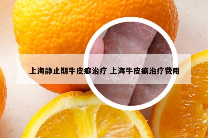 上海静止期牛皮癣治疗 上海牛皮癣治疗费用