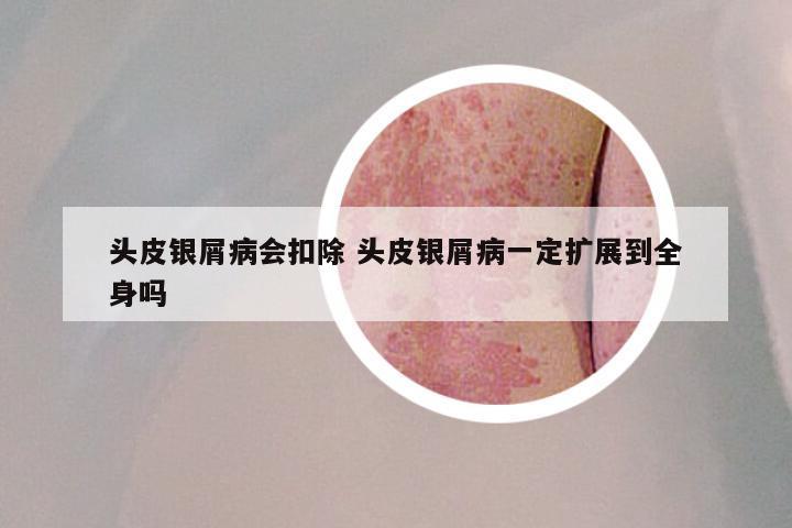 头皮银屑病会扣除 头皮银屑病一定扩展到全身吗