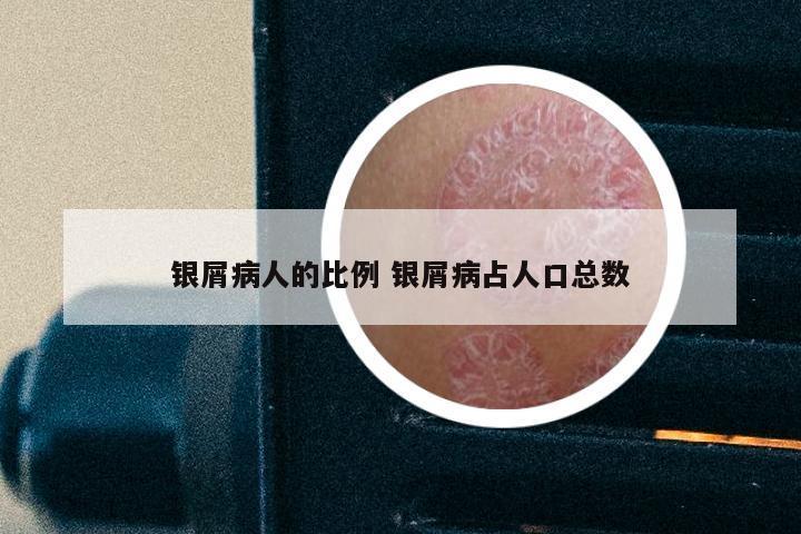 银屑病人的比例 银屑病占人口总数