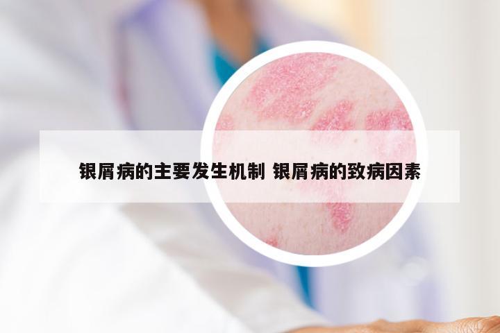 银屑病的主要发生机制 银屑病的致病因素