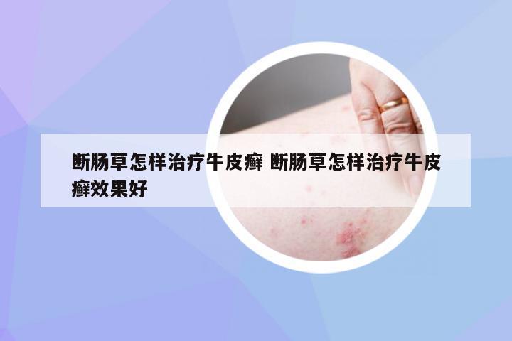 断肠草怎样治疗牛皮癣 断肠草怎样治疗牛皮癣效果好