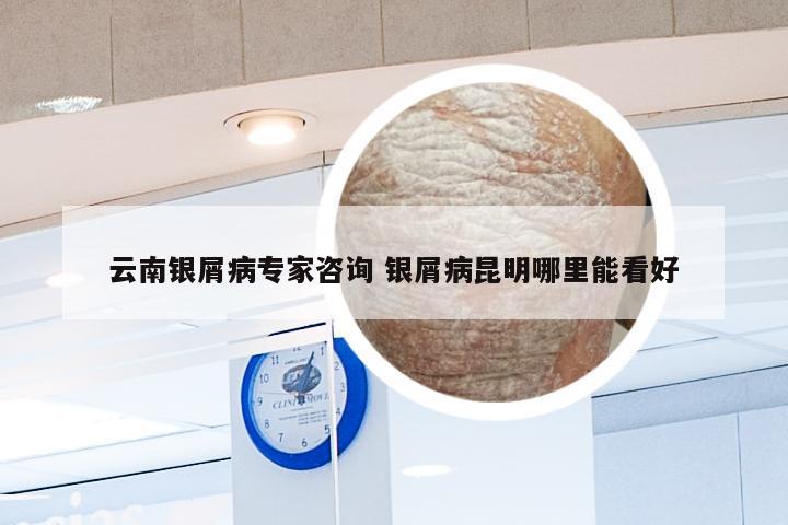 云南银屑病专家咨询 银屑病昆明哪里能看好