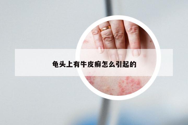 龟头上有牛皮癣怎么引起的